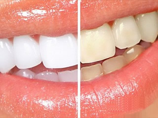 Blanqueamiento dental - Mercat Sants Dental
