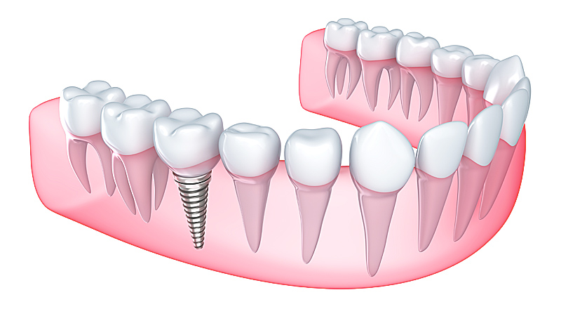 Implantologia dental - Mercat Sants Dental
