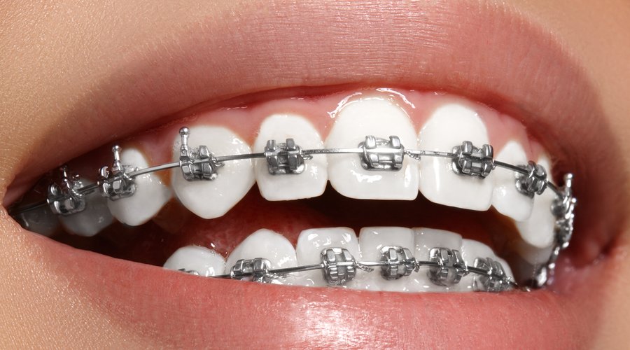 Ortodoncia -Mercat Sants Dental
